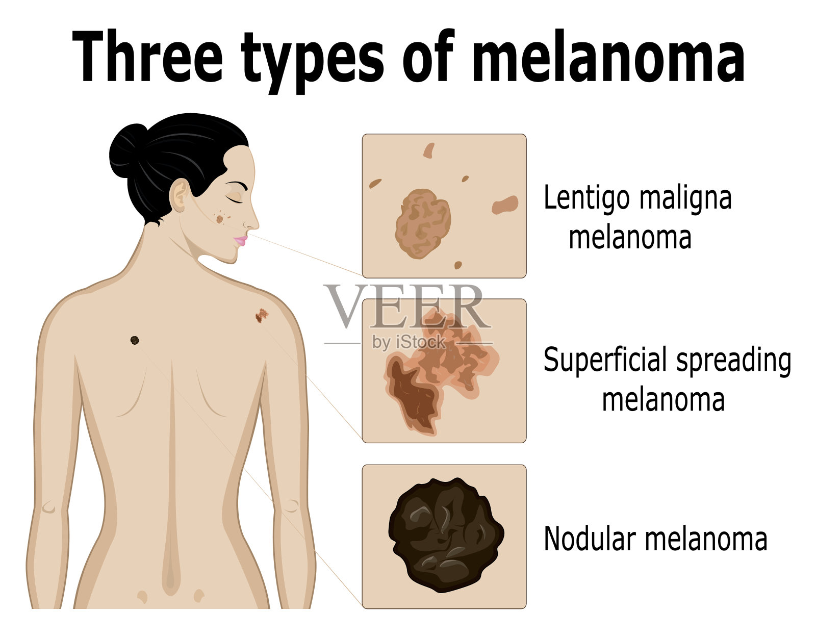 三种类型的黑色素瘤插画图片素材