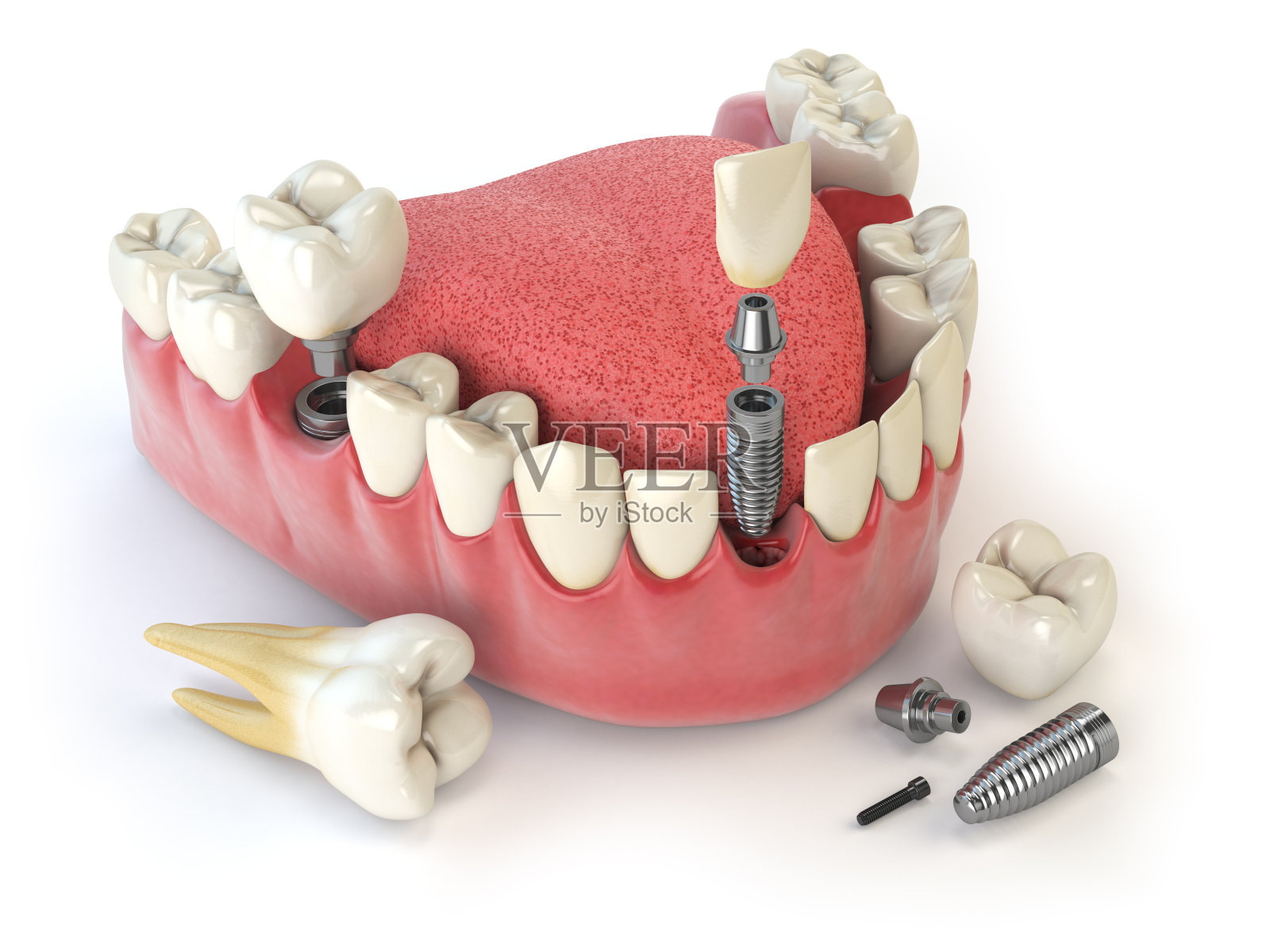 牙齿植入。牙科的概念。人的牙齿或假牙。照片摄影图片