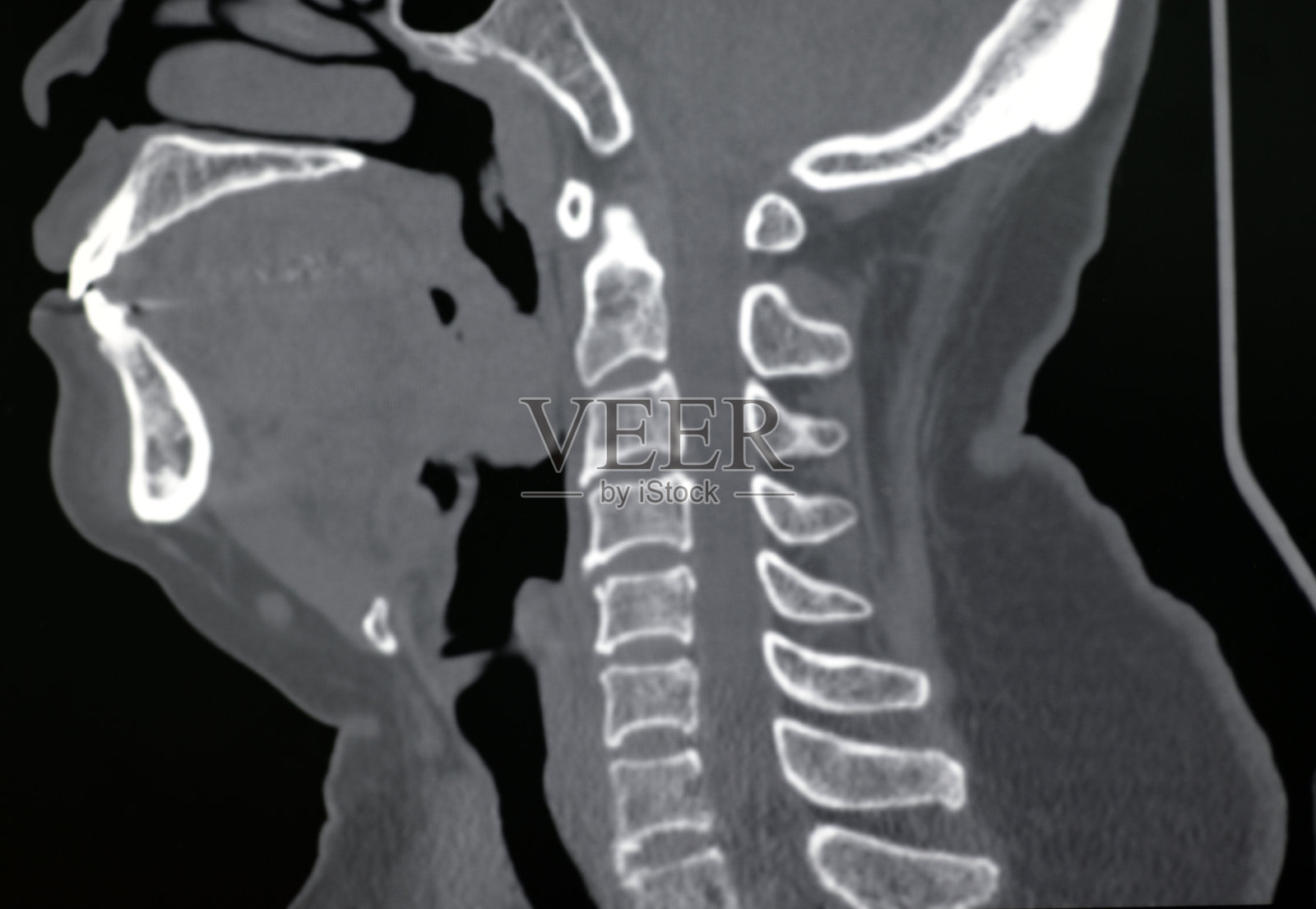人颈椎CT图像(骨窗)照片摄影图片