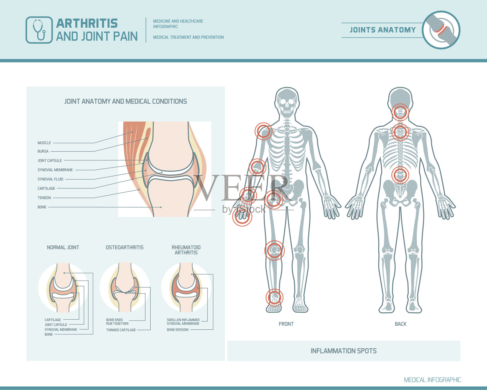 关节炎和关节疼痛信息图插画图片素材