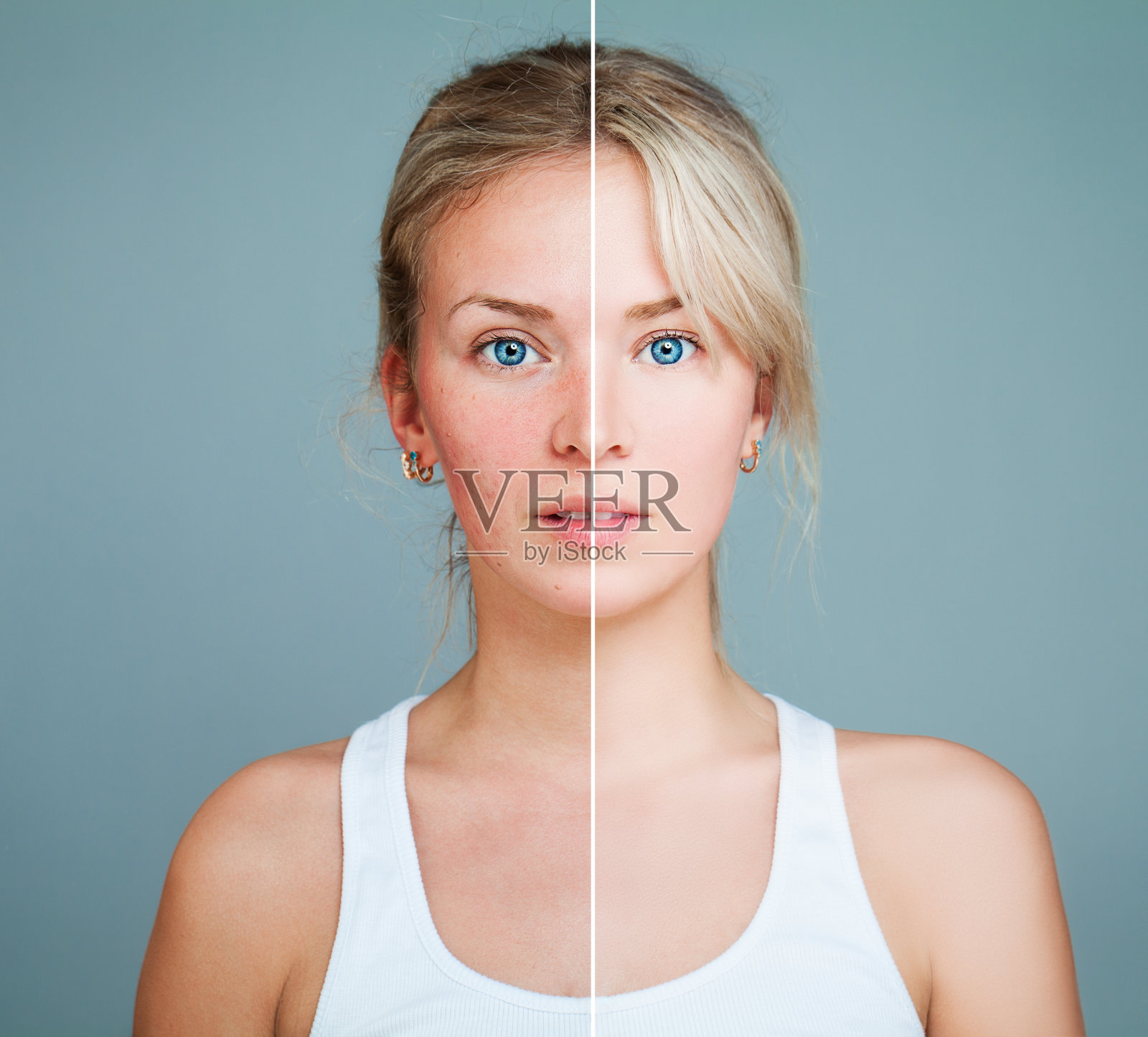 有皮肤问题的年轻模特。女性脸分为健康和不健康两部分。面部治疗，医学和美容概念照片摄影图片