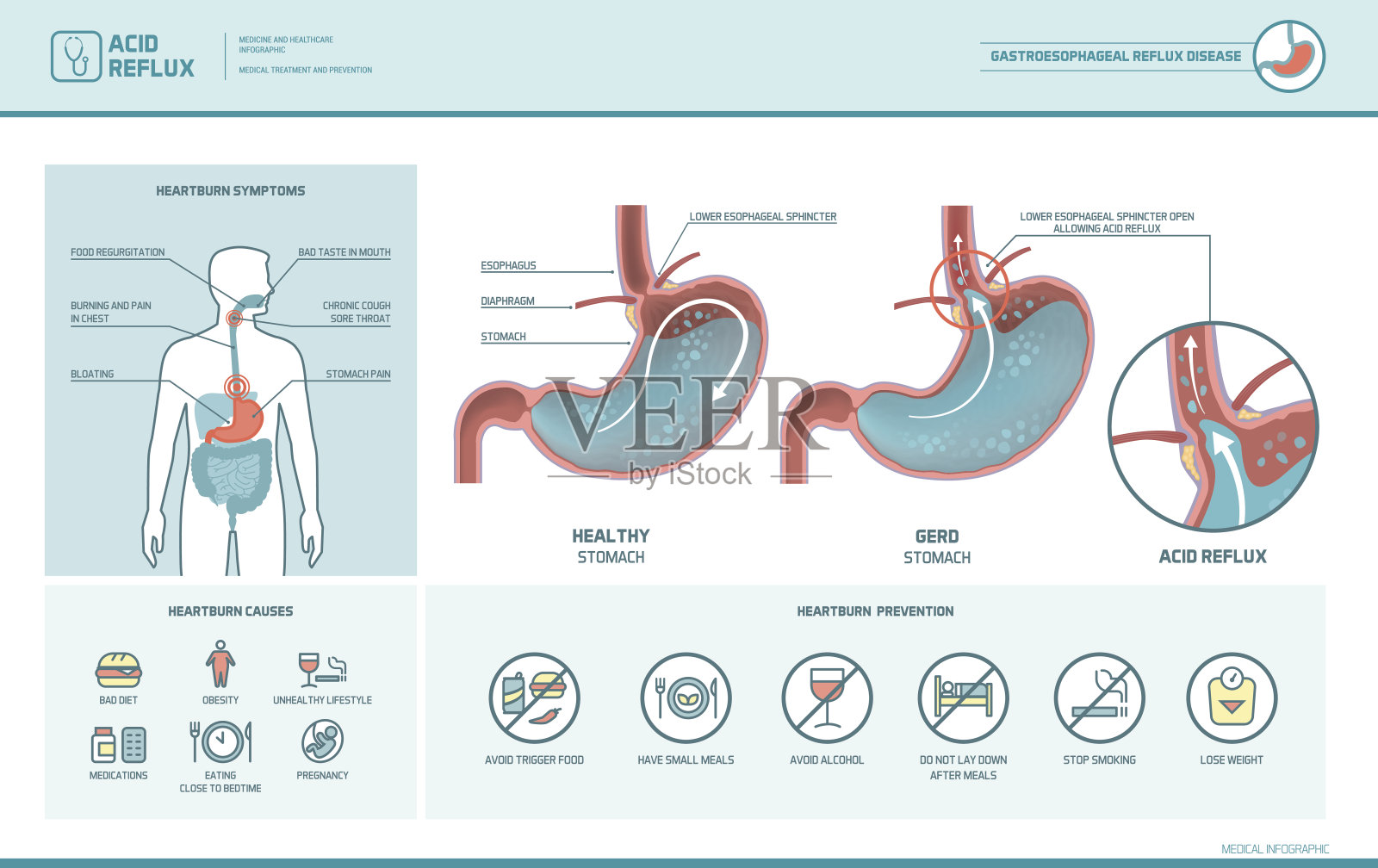 胃酸倒流和烧心信息图插画图片素材