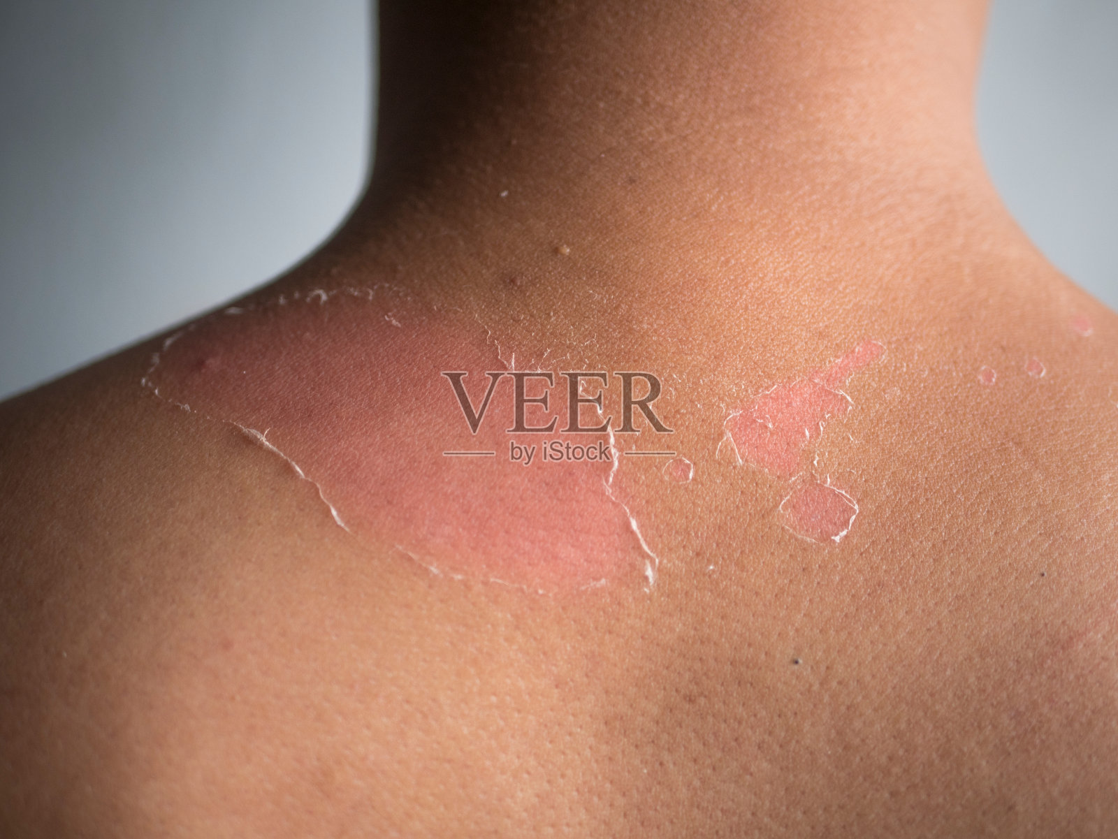 年轻人夏季晒伤后背部和肩部皮肤脱皮。危险的晒伤的概念照片摄影图片