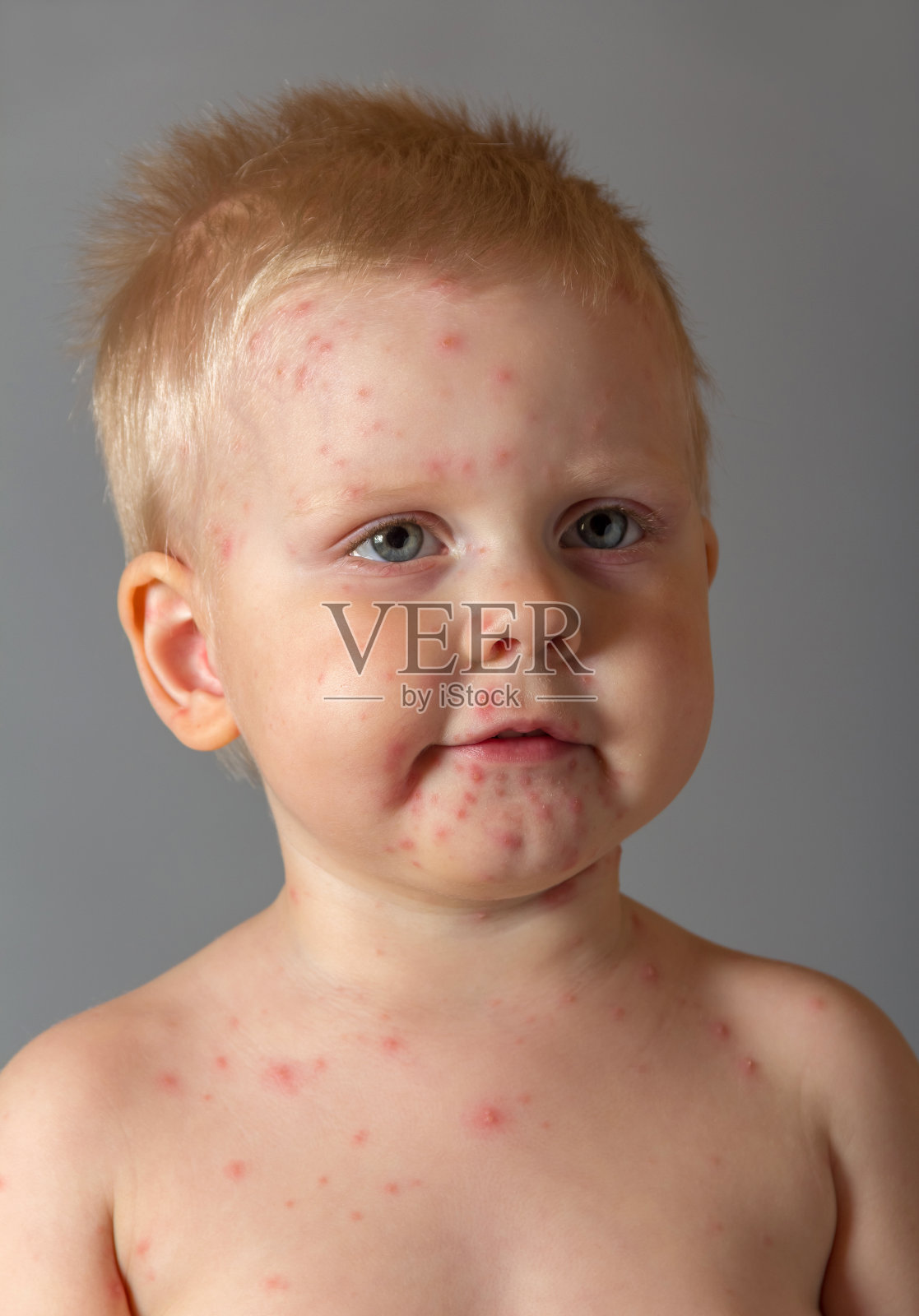 生水痘的男孩，身上出疹子，上了灰照片摄影图片