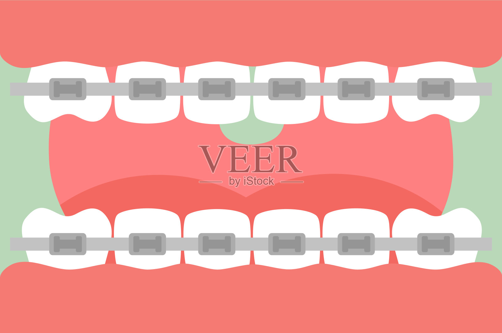 矫正牙齿或牙套，张开嘴，牙齿和舌头健康插画图片素材
