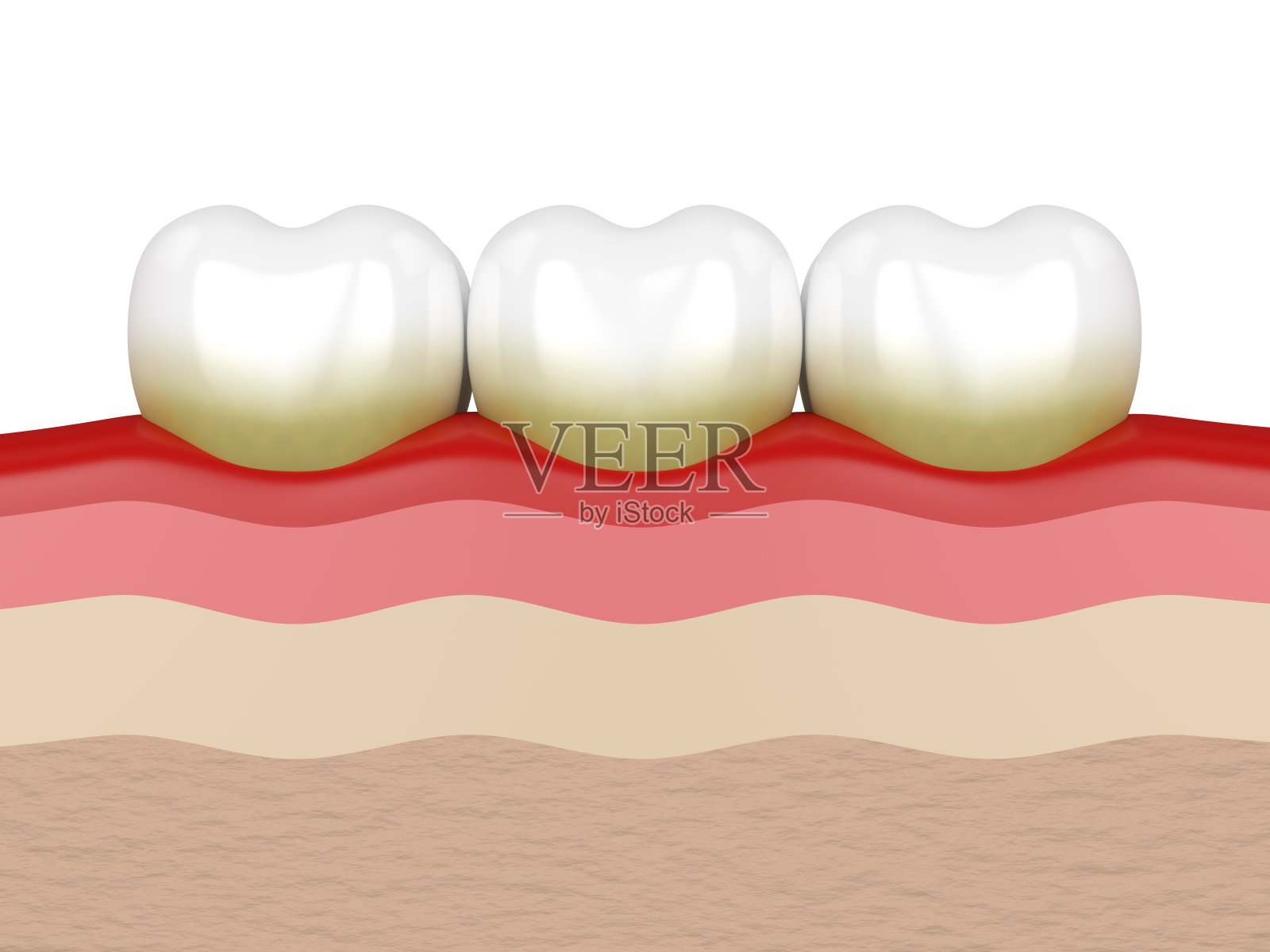 牙菌斑和牙垢的3d渲染插画图片素材