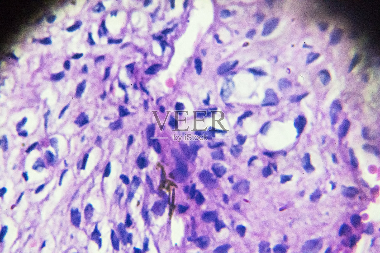 卵巢囊腺瘤不同部位光镜下活检照片摄影图片