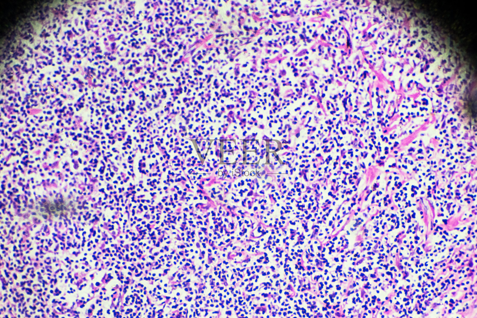 何杰金氏细胞病，淋巴瘤，显微镜下的HL照片摄影图片