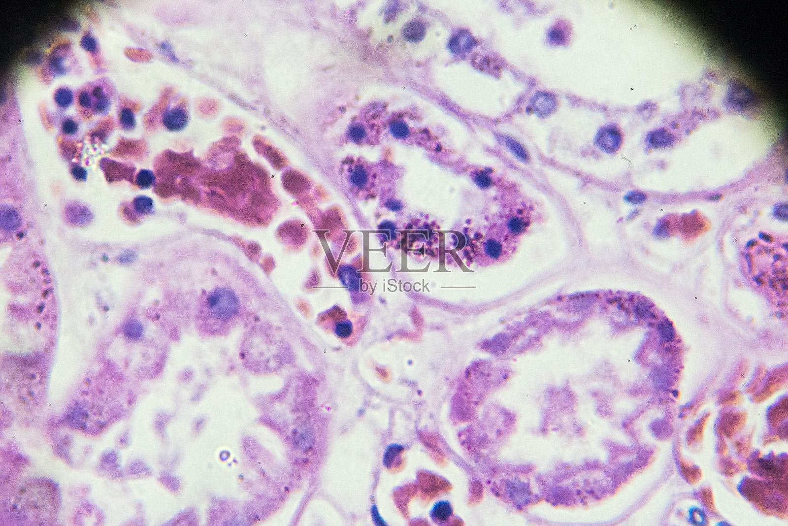 显微镜下急性肾炎活检标本照片摄影图片