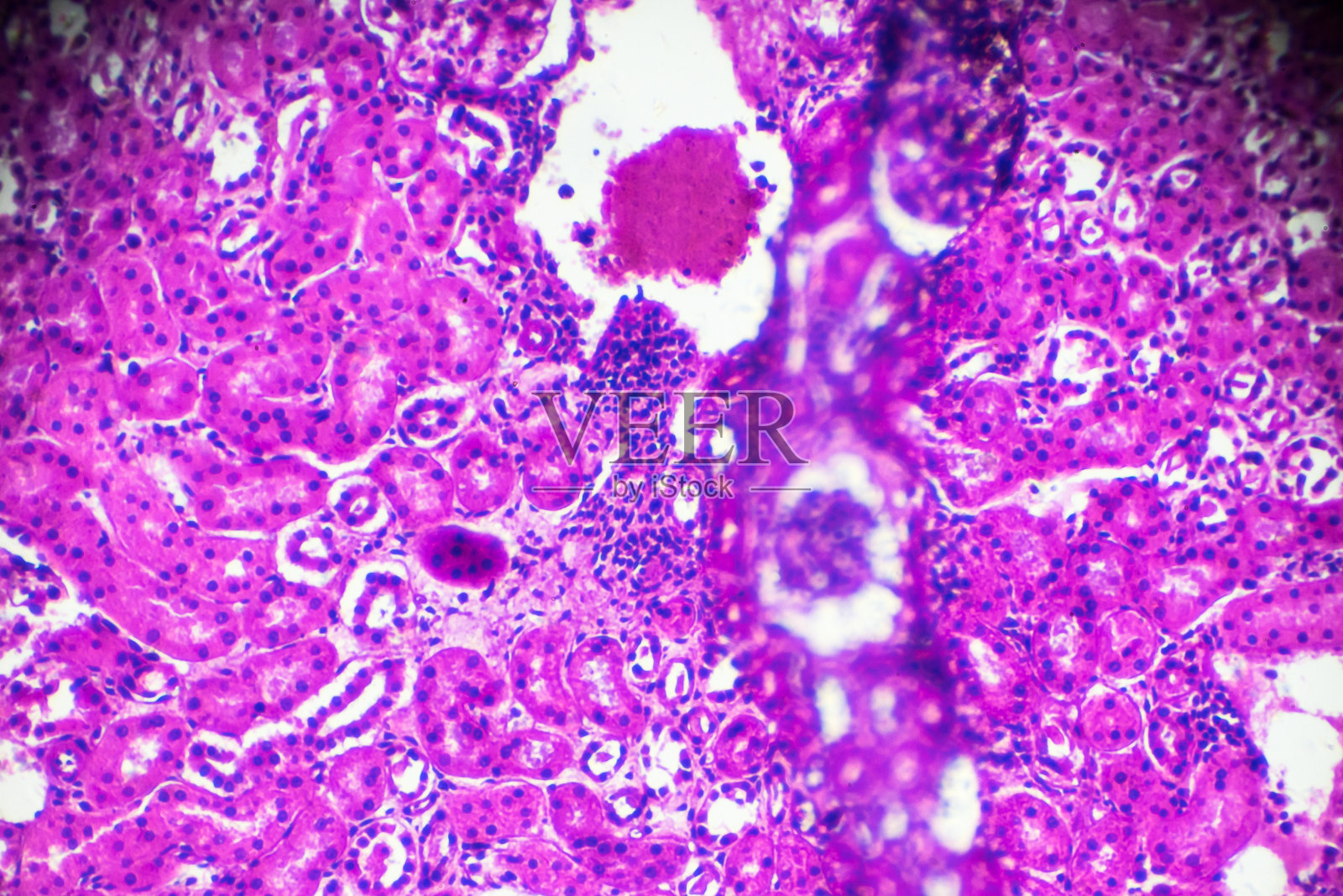 显微镜下急性肾盂肾炎活检标本照片摄影图片