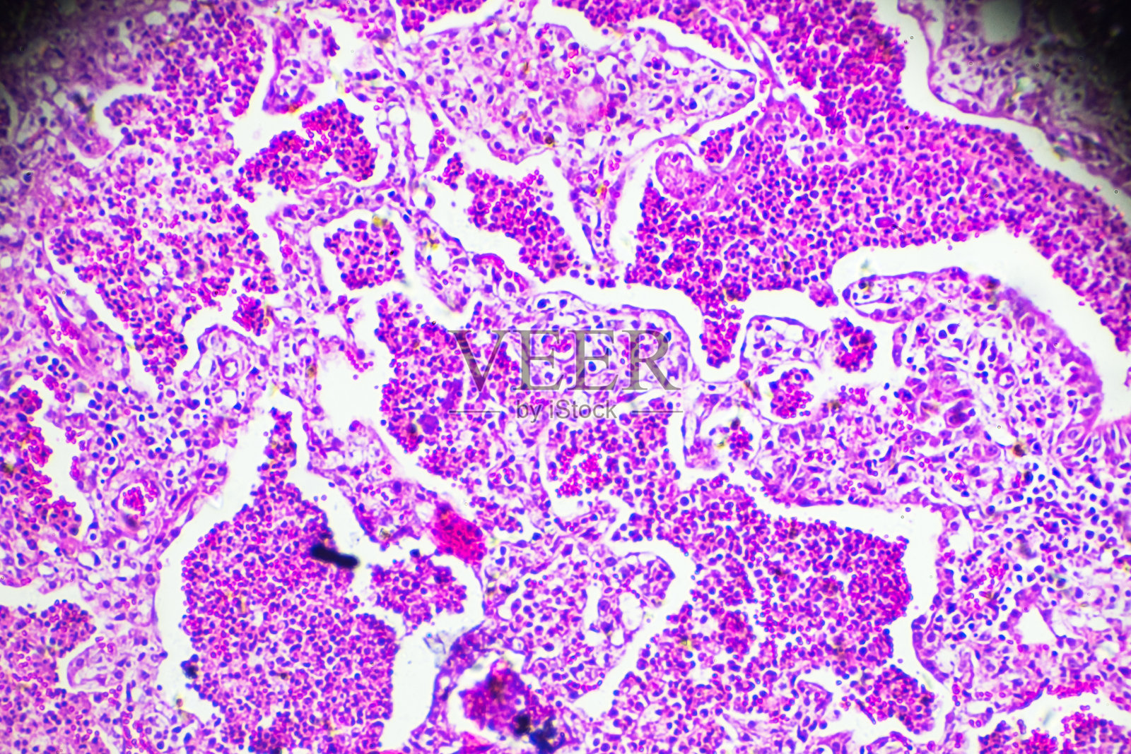 大叶性肺炎人类生物样本显微镜下照片摄影图片
