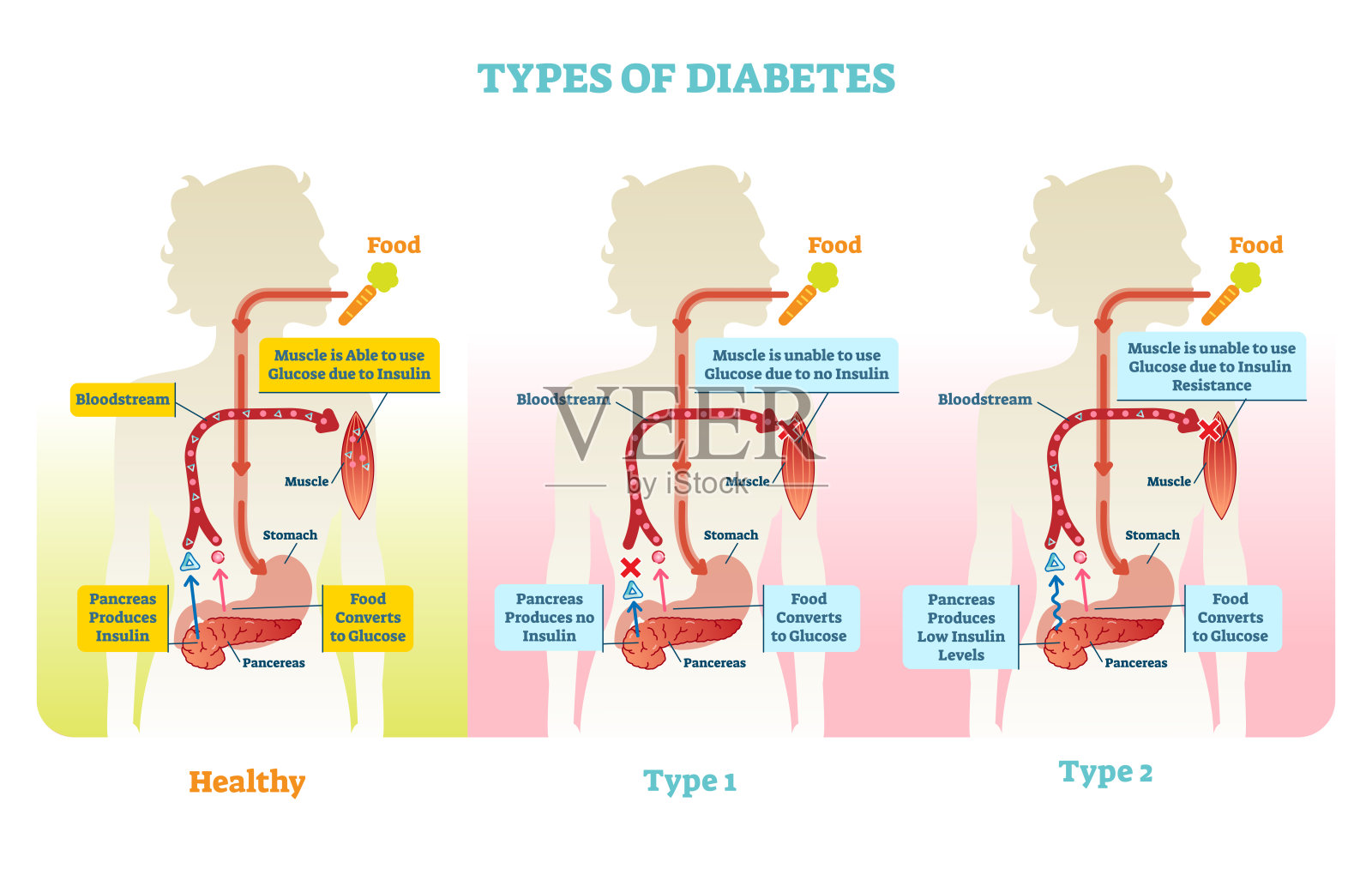 糖尿病类型矢量图解方案设计元素图片