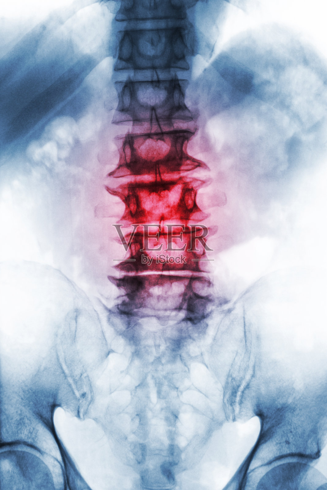 脊椎病。老年患者腰骶椎x线片显示骨赘、退行性椎体塌陷。前视图照片摄影图片