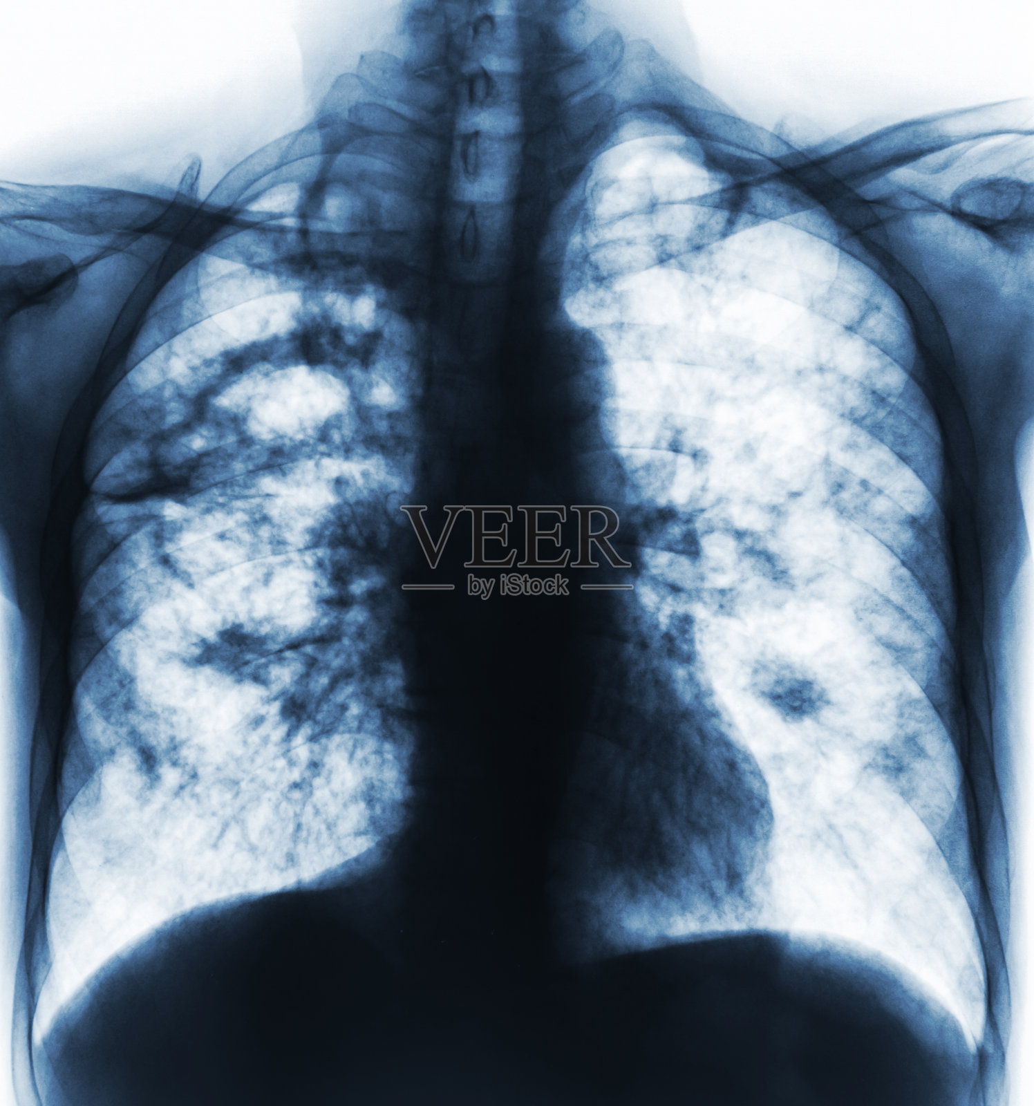 肺结核。胸部x线片显示右肺有空洞，两肺间质因结核感染而浸润照片摄影图片