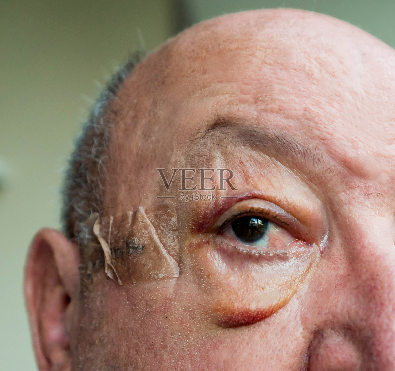手术后老年男性面部水肿的特写照片摄影图片