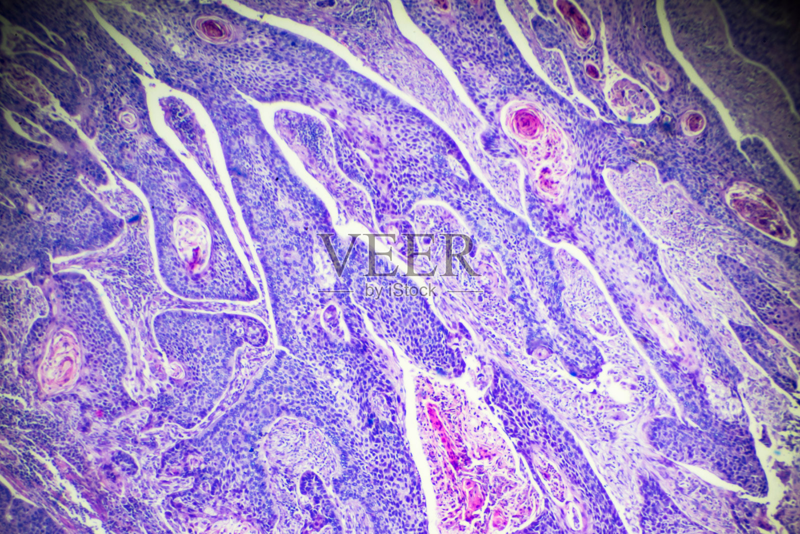 食管癌(高分化鳞状病变)照片摄影图片