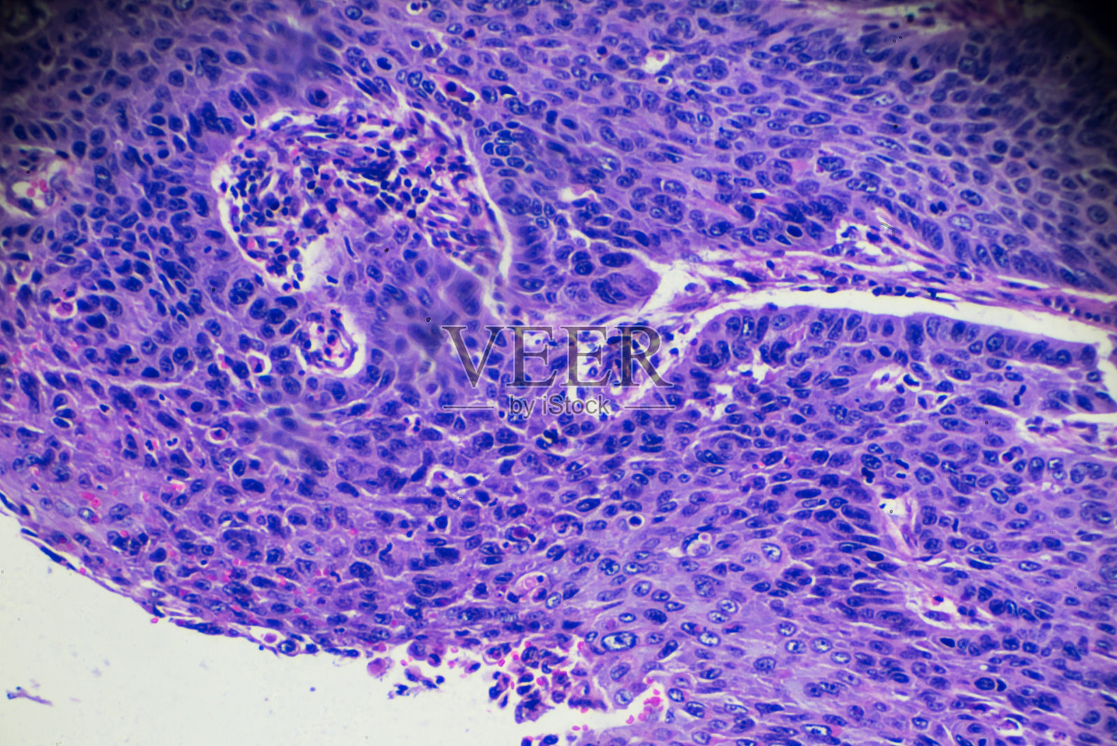 食管癌(高分化鳞状病变)照片摄影图片