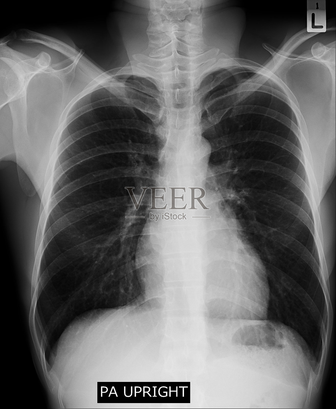 健康人的胸部x光片可以看到颈骨、肺、心脏、脊柱、锁骨、隔膜照片摄影图片