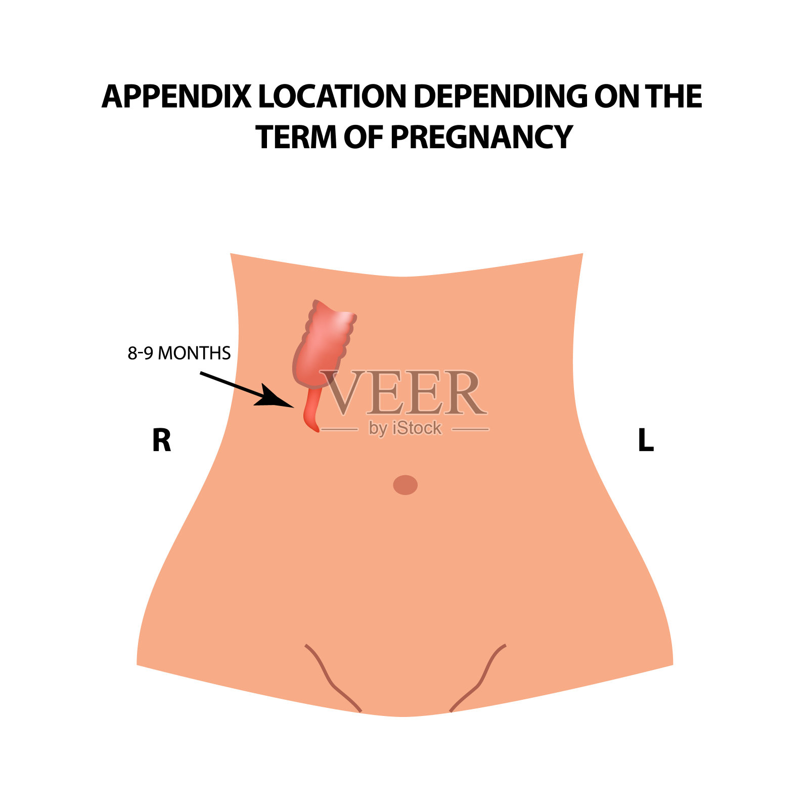 阑尾的位置取决于妊娠期。8 - 9个月。信息图。矢量插图在孤立的背景。插画图片素材