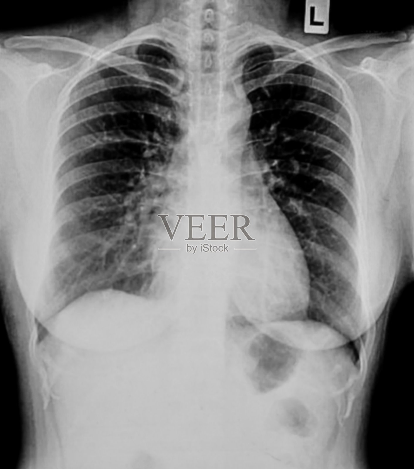胸部x射线照片摄影图片