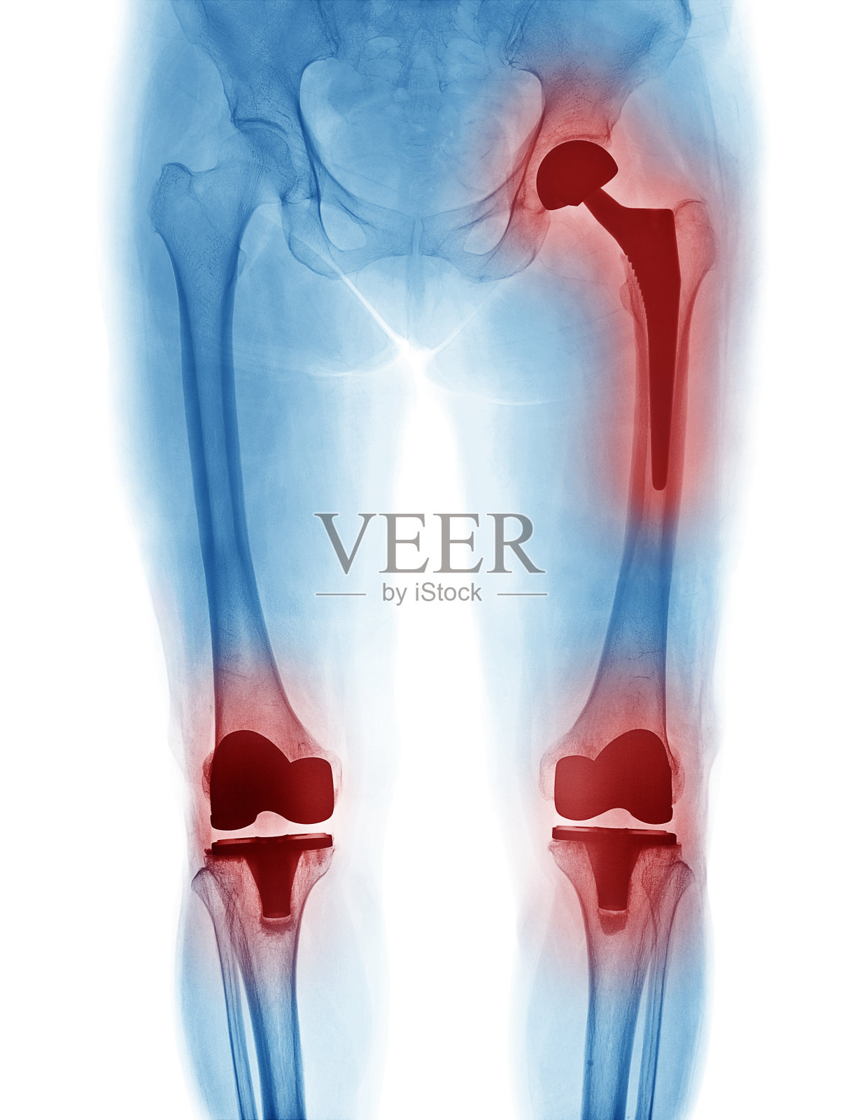 白色背景下孤立的髋关节置换和膝关节置换的X线图像照片摄影图片