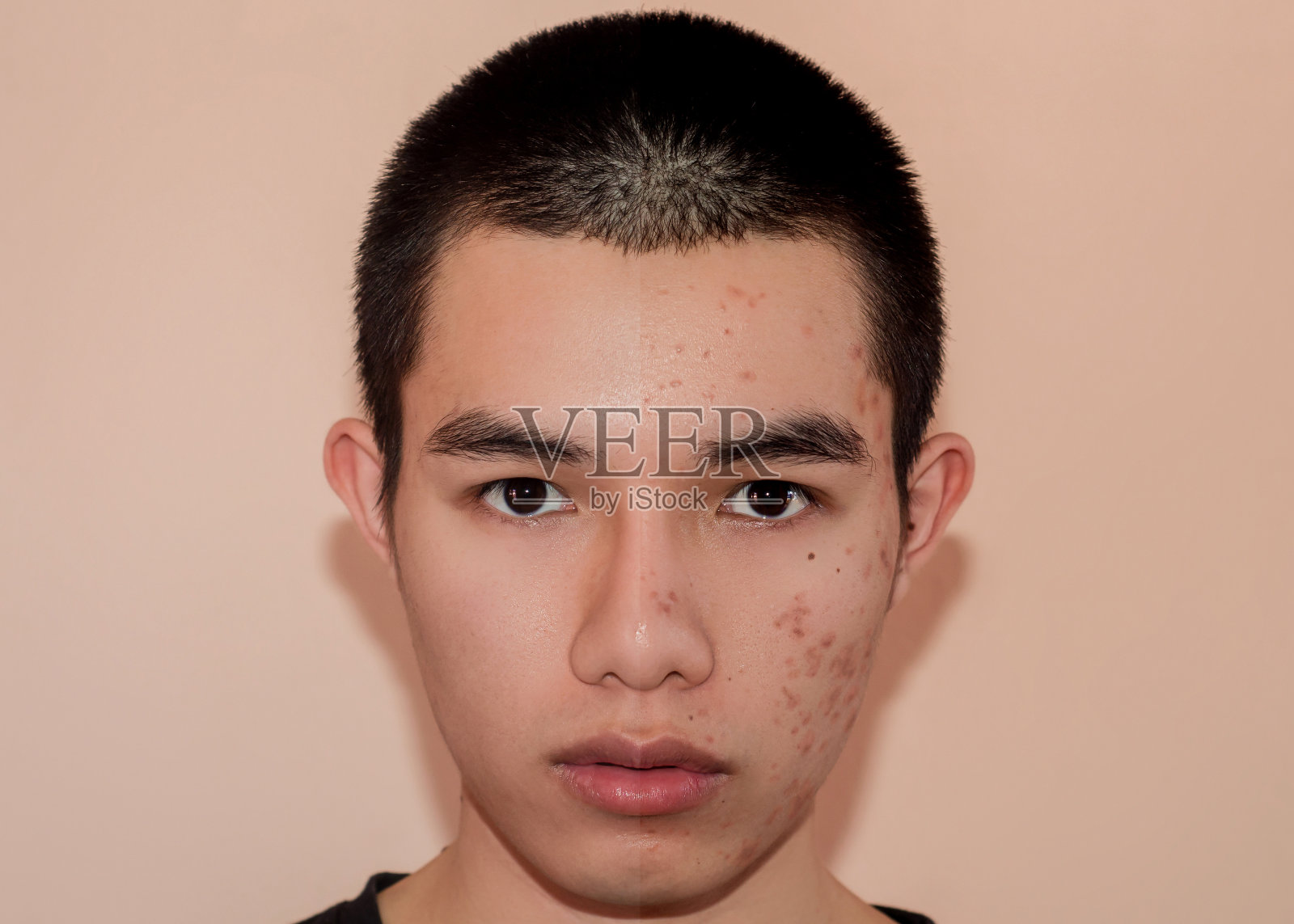 青年男子治疗前后由痤疮和丘疹去除痤疮。照片摄影图片