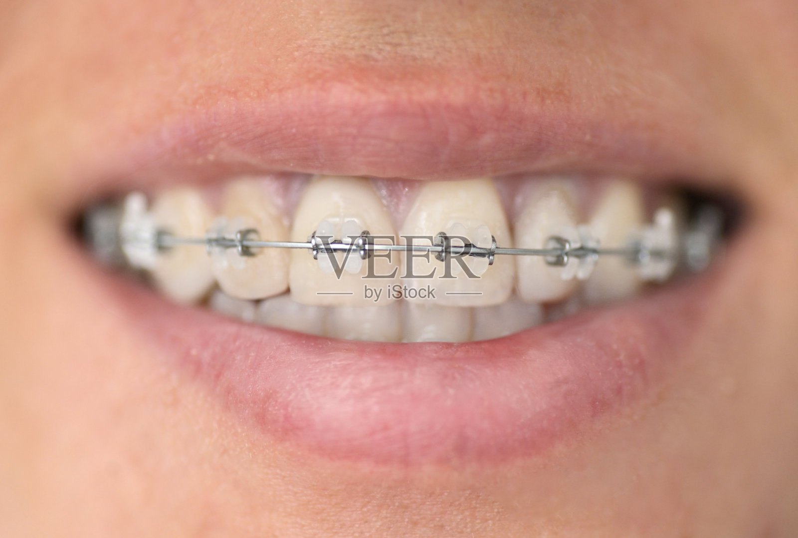 支架系统在微笑的嘴，微距照片的牙齿，特写嘴唇照片摄影图片