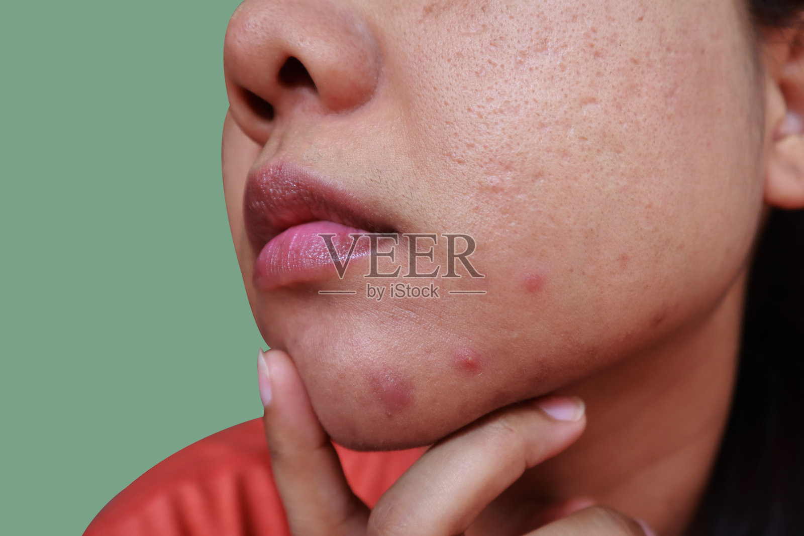 面部脓疱白头粉刺，女性皮肤上痤疮和疤痕的问题，皮肤问题照片摄影图片