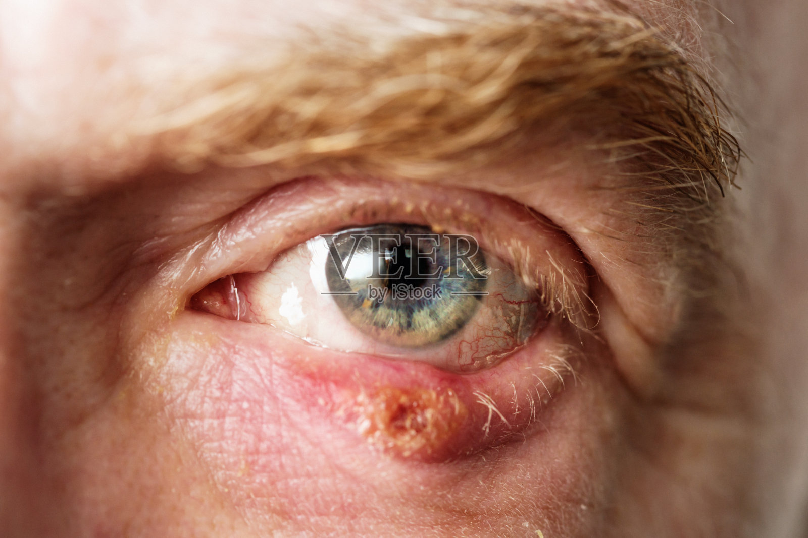 男人受感染的眼睛下眼睑有霰粒肿，一种皮脂腺阻塞照片摄影图片
