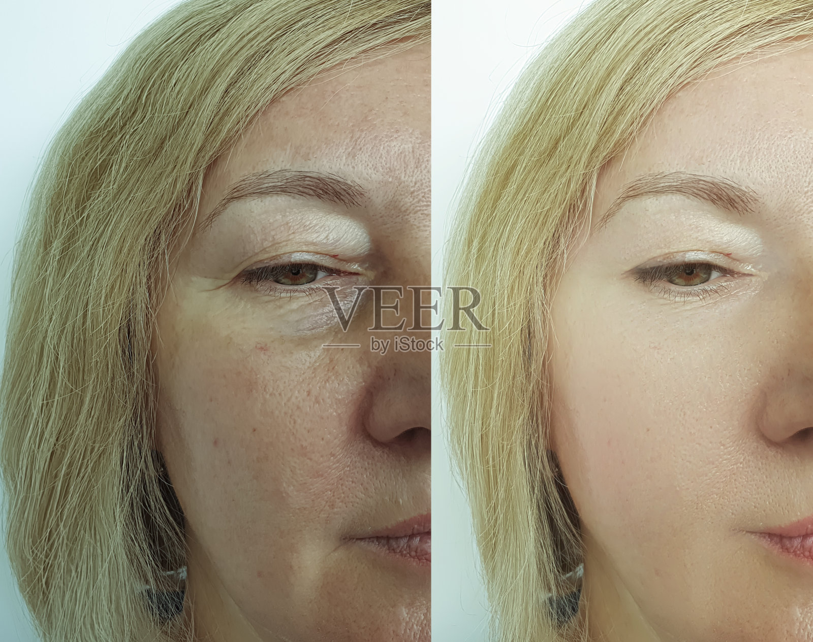女人脸部皱纹治疗前后拼贴照片摄影图片