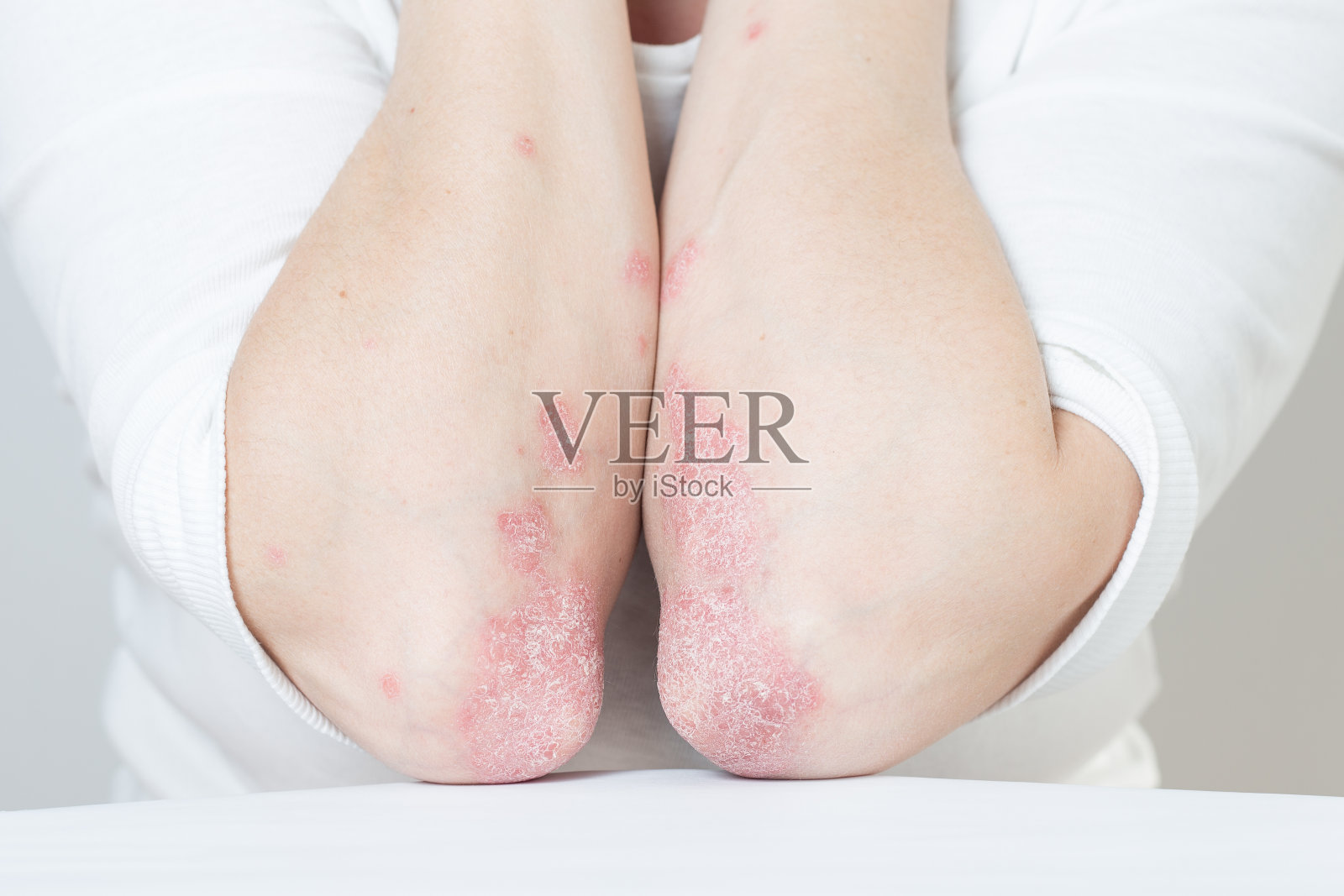 急性肘部银屑病是一种自身免疫性不可治愈的皮肤病。膝盖上有大片红肿片状皮疹。受银屑病关节炎影响的关节照片摄影图片
