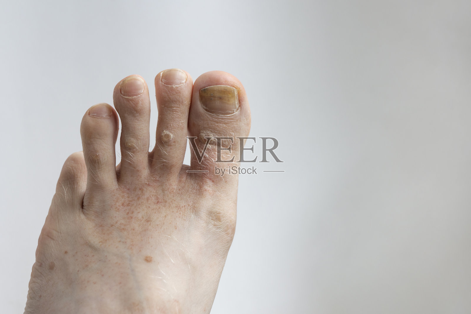 有指甲真菌和皮肤病的脚照片摄影图片