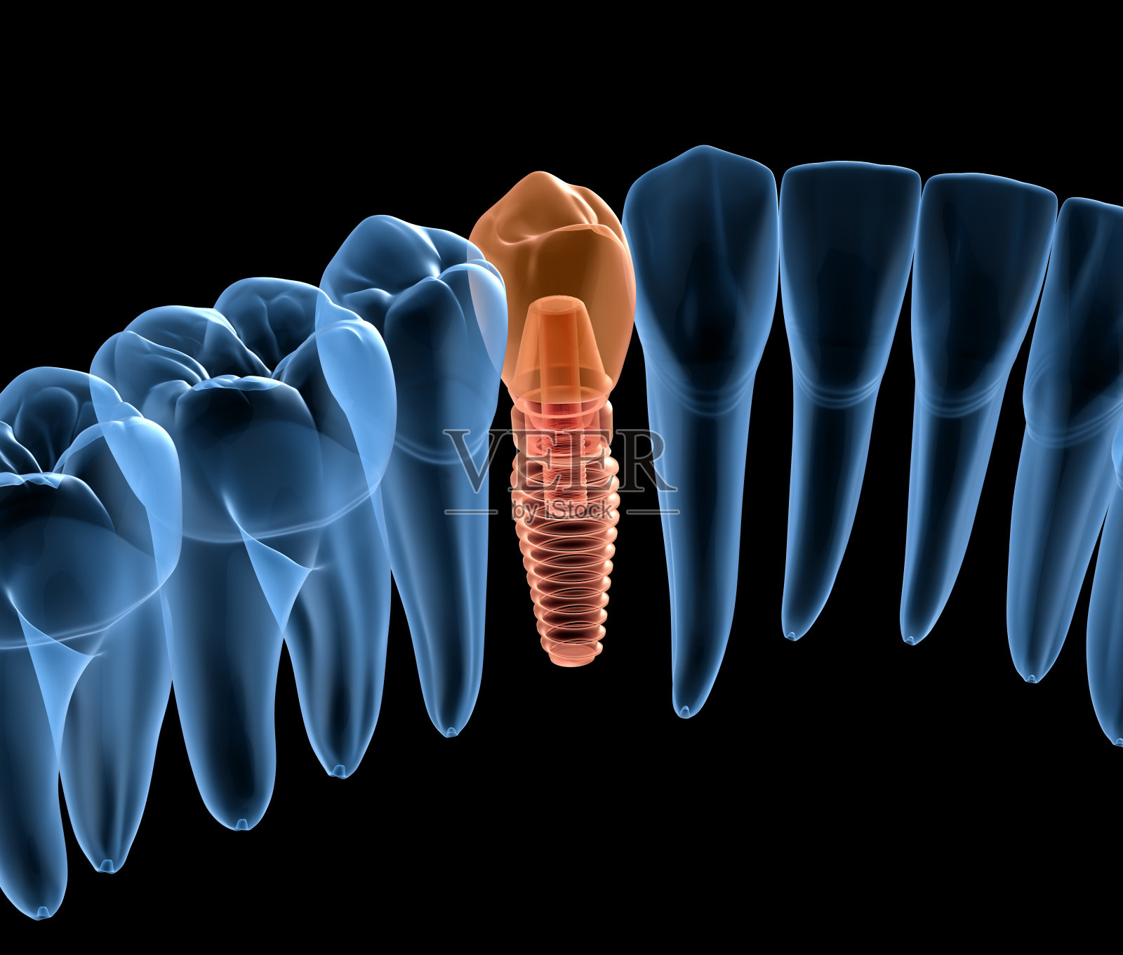 牙齿恢复种植，x光片。医学上精确的人类牙齿和假牙概念的3D插图照片摄影图片