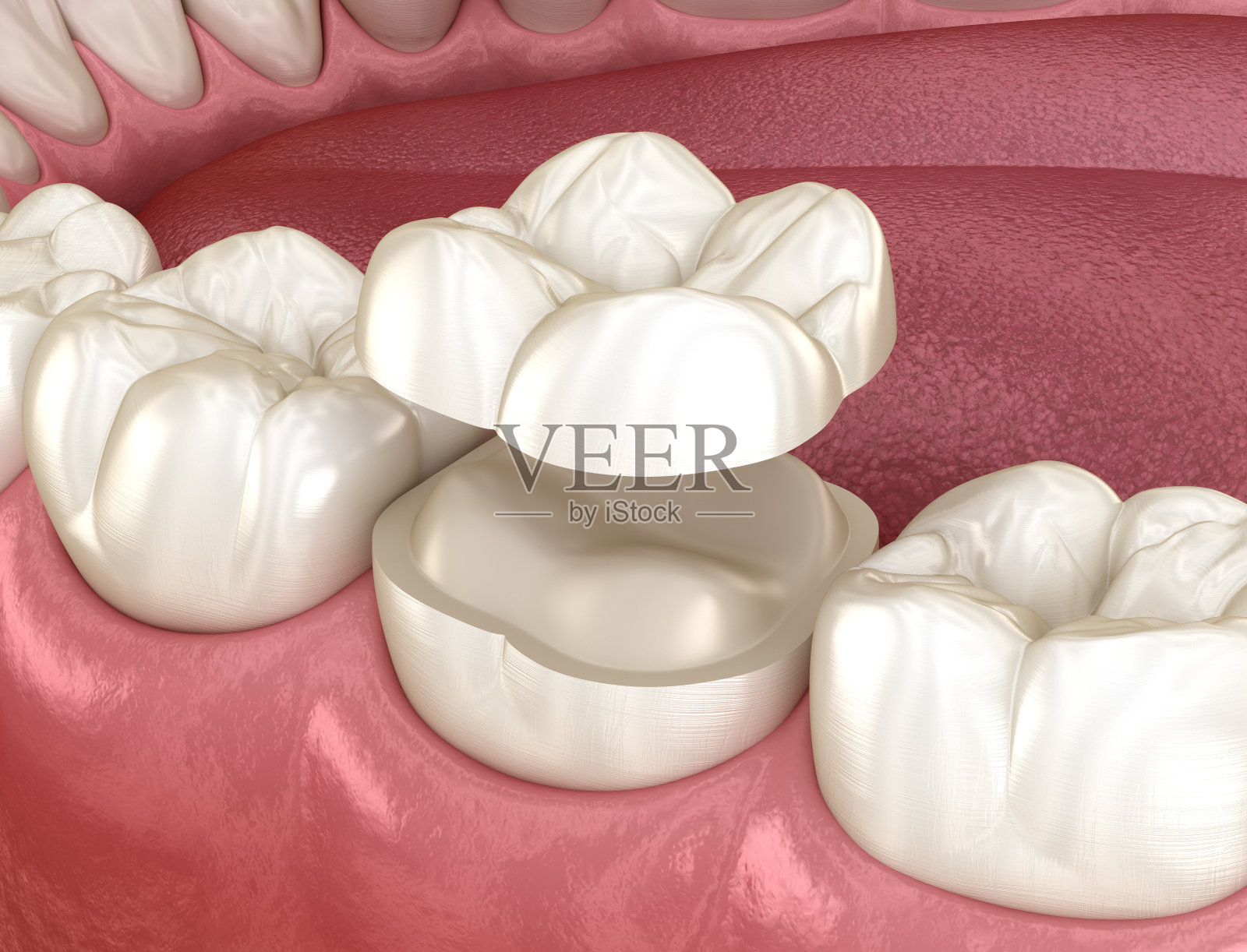 高嵌瓷冠固定在牙齿上。医学上精确的人类牙齿治疗的3D插图照片摄影图片