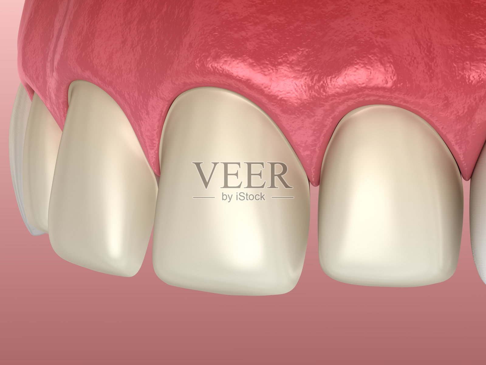 中切牙和侧切牙贴面安装前的牙齿准备。医学上准确的牙齿3D插图照片摄影图片