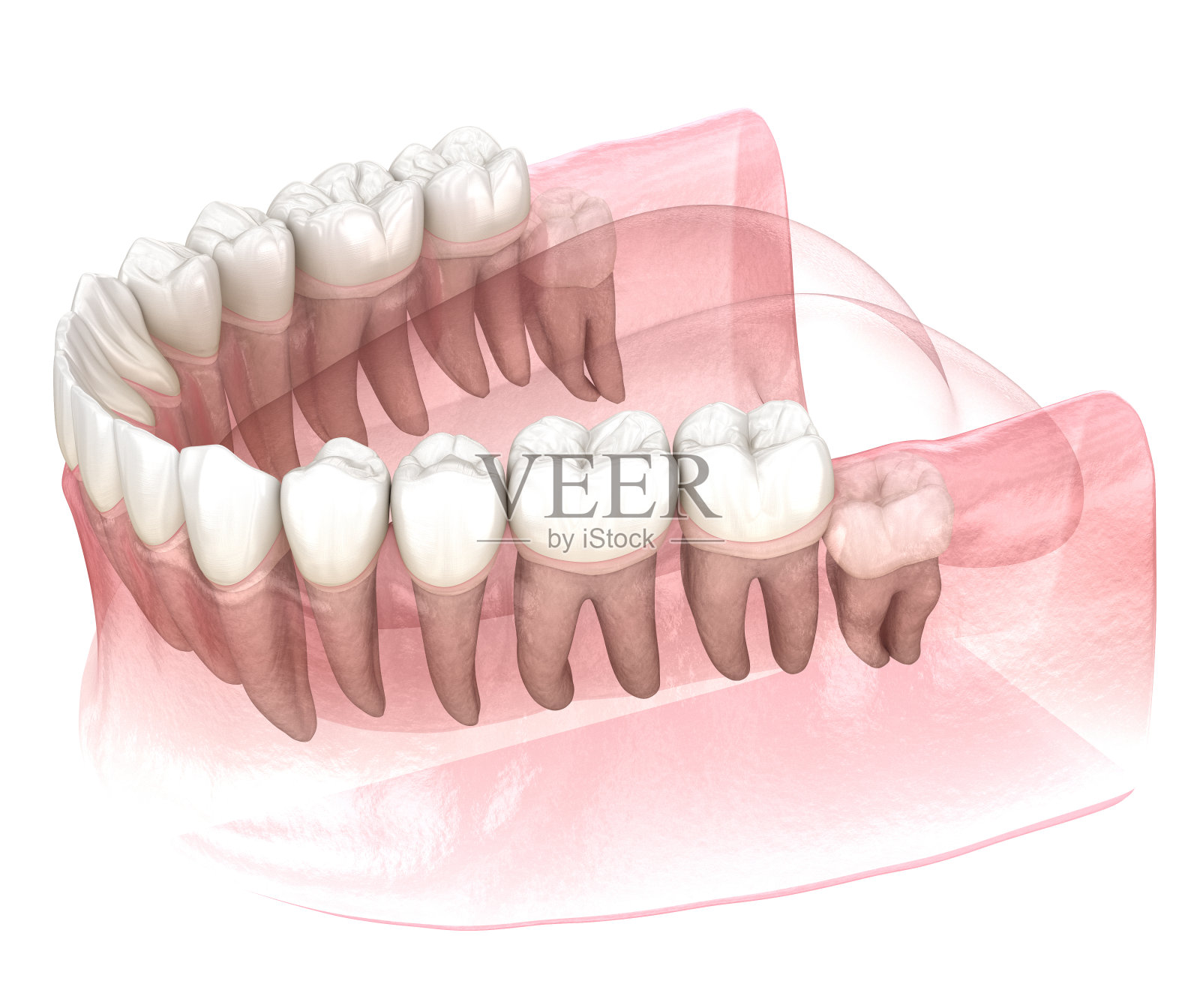智齿垂直嵌顿。医学上准确的牙齿3D插图照片摄影图片