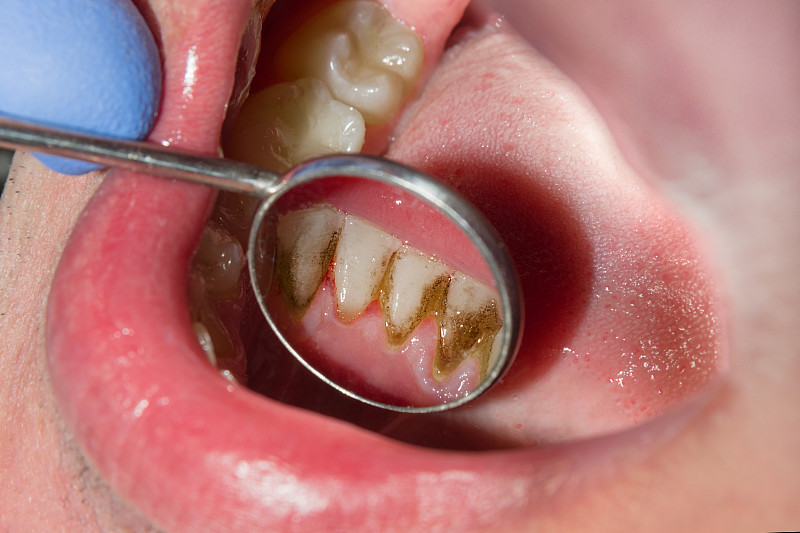宏观牙石和牙菌斑的特写牙科中的口腔卫生图片下载